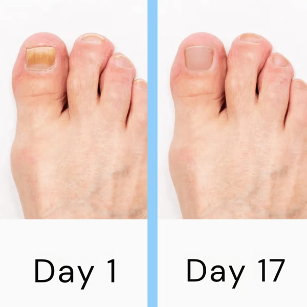 Fast Fungal Nail Removal Tool