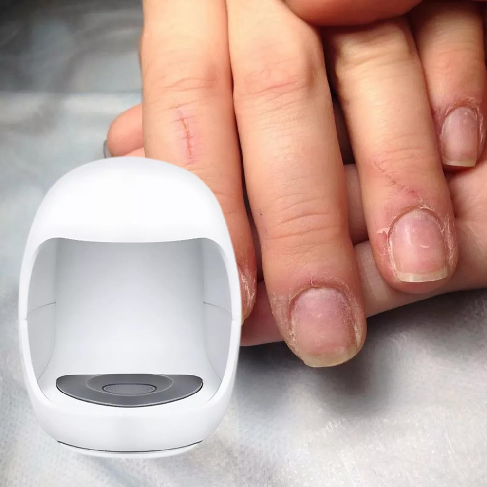 Easy To Use At Home Fungus Laser Treatment Device