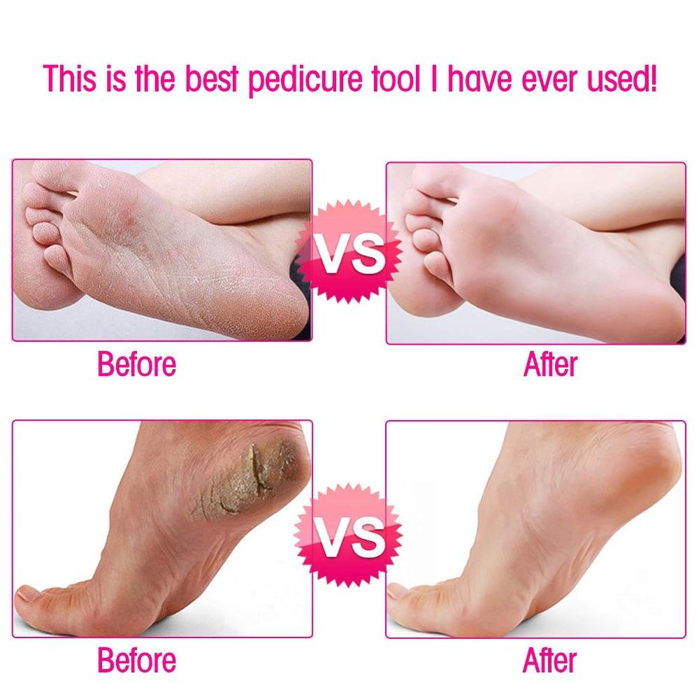 Effective Foot Callus Shaver Tool