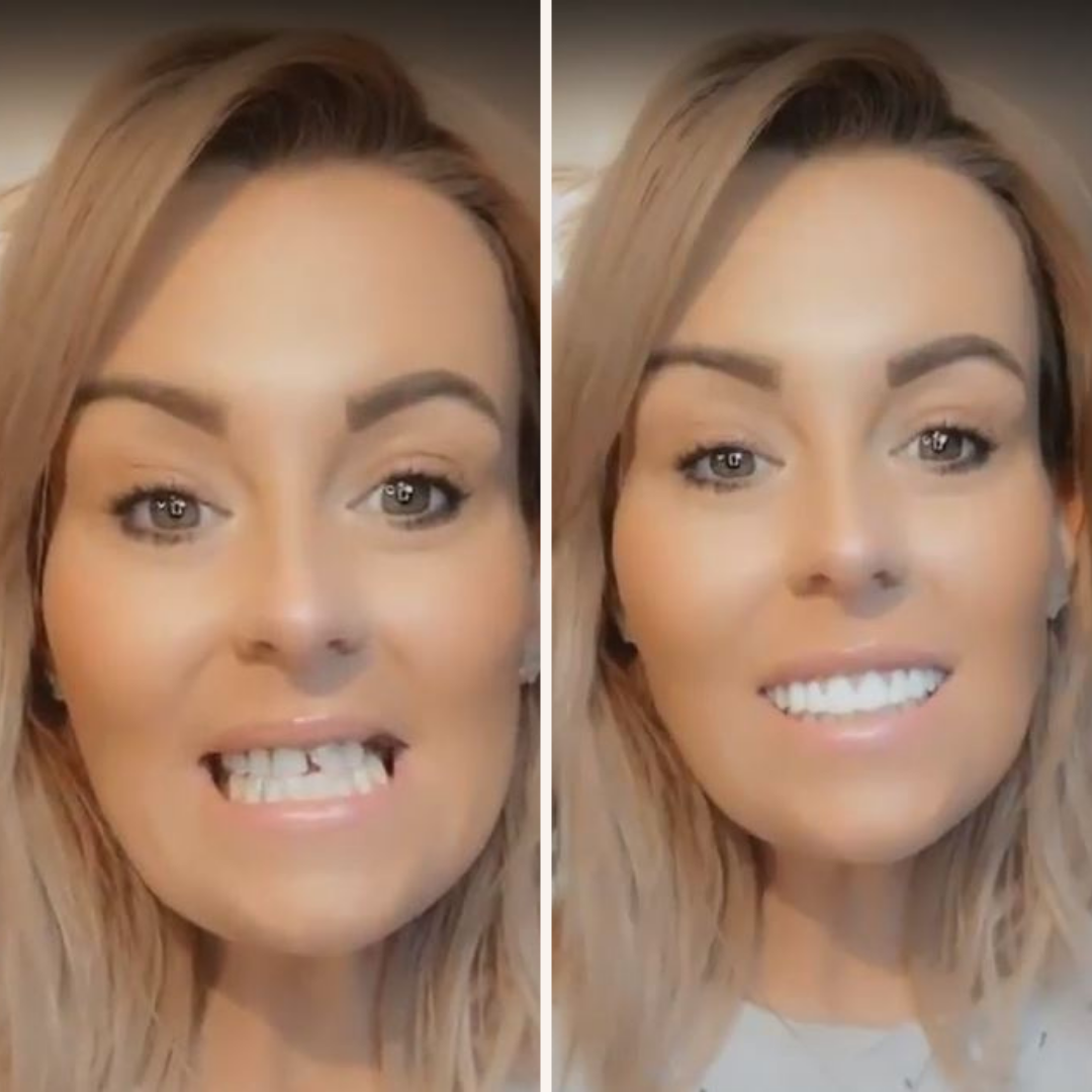 At Home Teeth Veneer Kit Easy Smile Solution