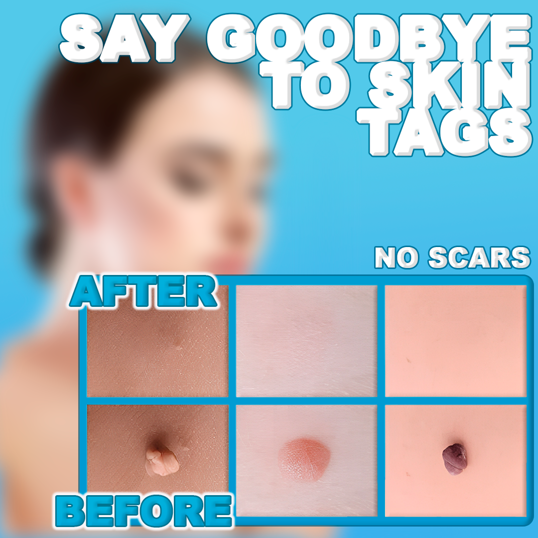 Easy At-Home Skin Tag and Mole Remover Pen