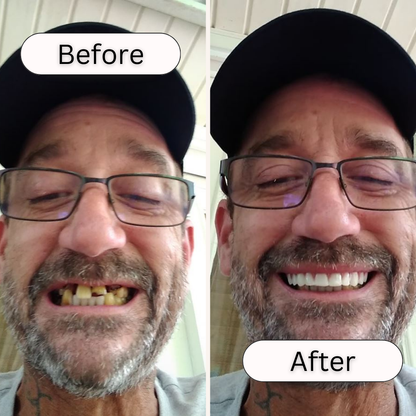 At Home Teeth Veneer Kit Easy Smile Solution