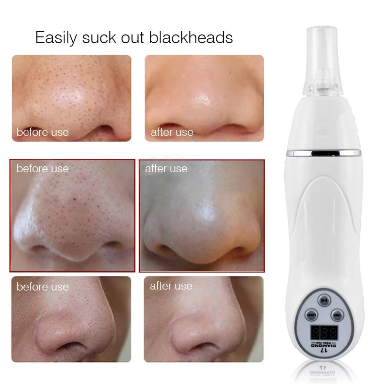 Electric Microdermabrasion Blackhead Remover Vacuum Pore Cleanser Tool