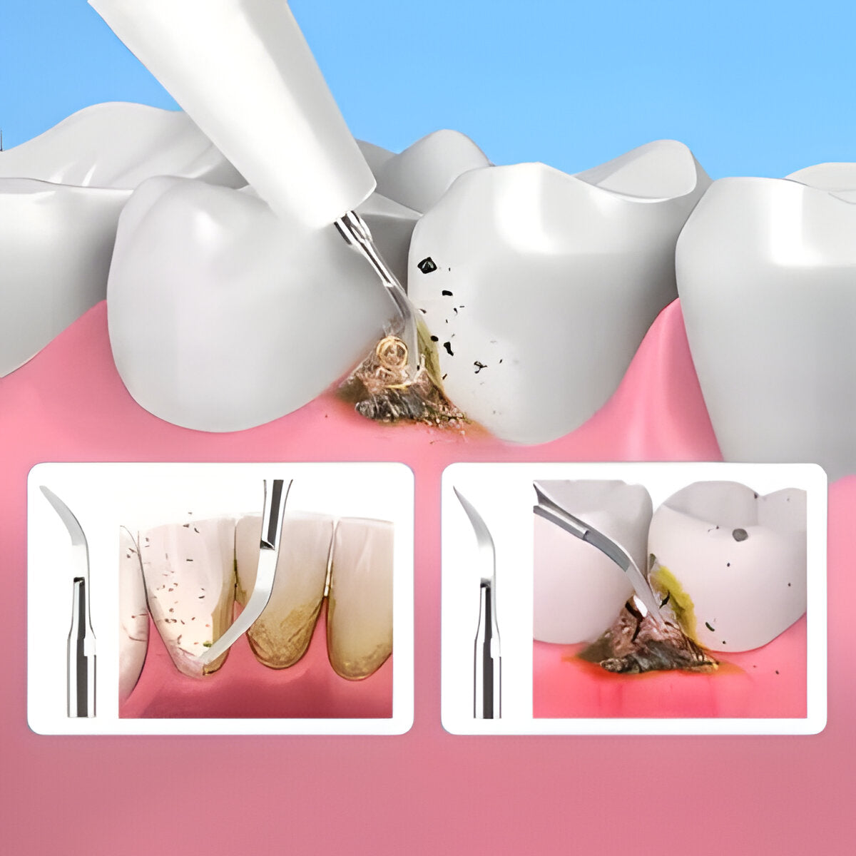 Professional Dental Cleaning Tool