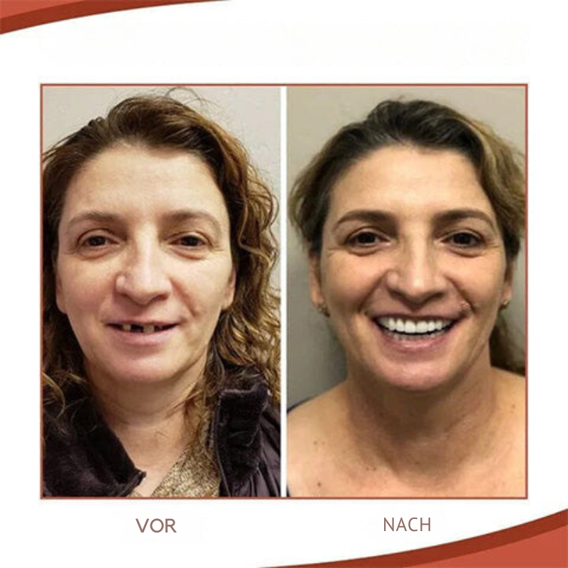 Comfortable Silicone Dental Prosthesis Set for Natural Smile - Halri