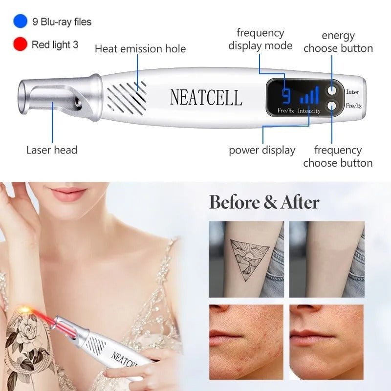 Picosecond Laser Pen for Mole, Dark Spot, Tattoo, Acne, and Skin Pigment Removal