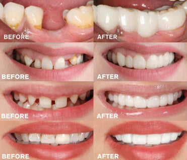 SecureFit - EasyWear Dental Prosthetic
