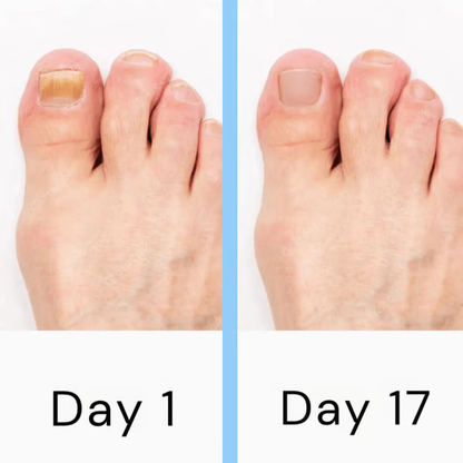 Fast Fungal Nail Removal Tool
