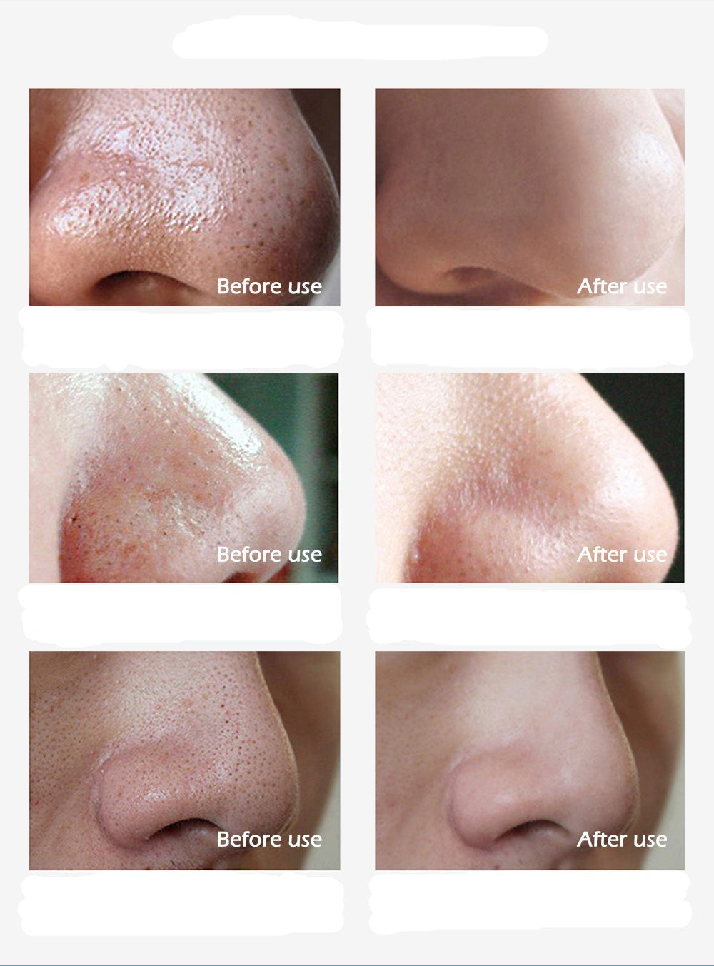 Easy Pore Cleansing Blackhead Removal Strips