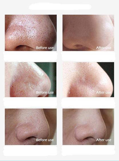Easy Pore Cleansing Blackhead Removal Strips