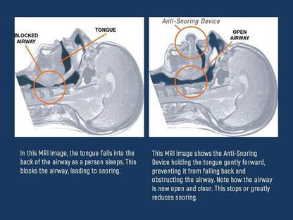 Sleep Aid Anti Snore Mouthpiece Device